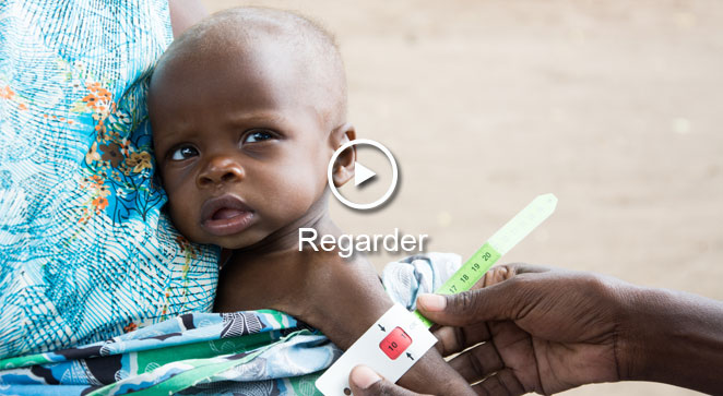 Edward souffre de malnutrition sévère aige.